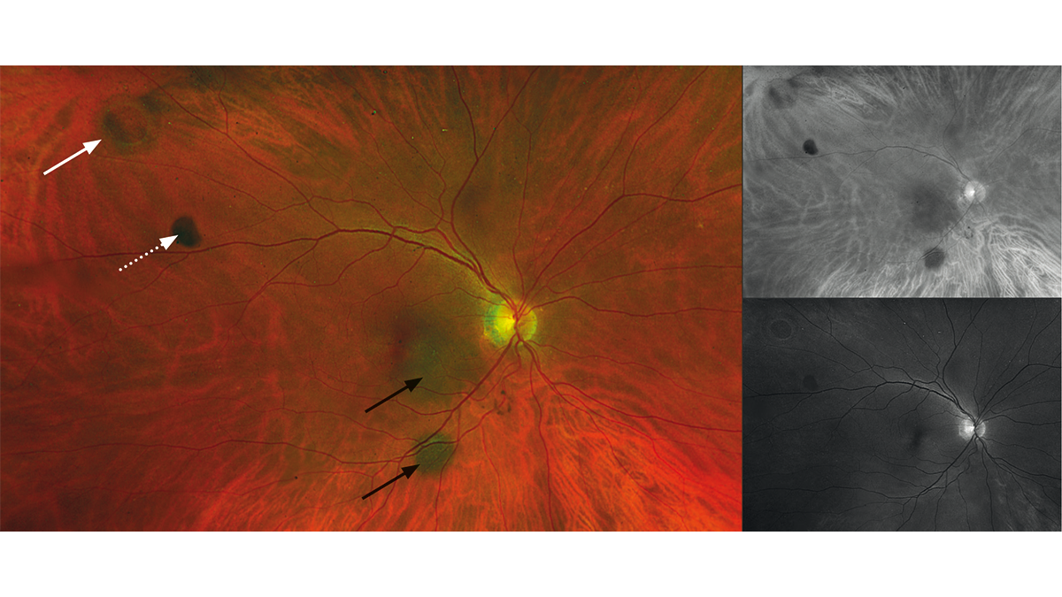 Ocular fundus of the right eye with retinal hole
