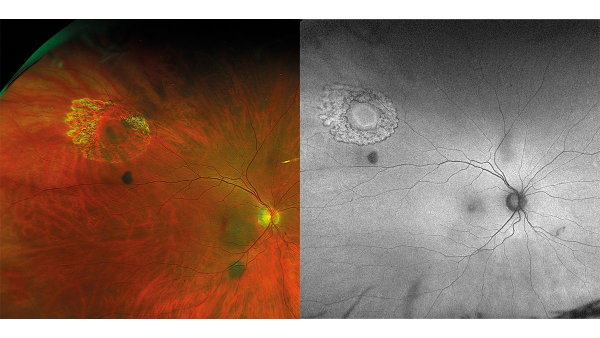 Retinal hole after laser coagulation